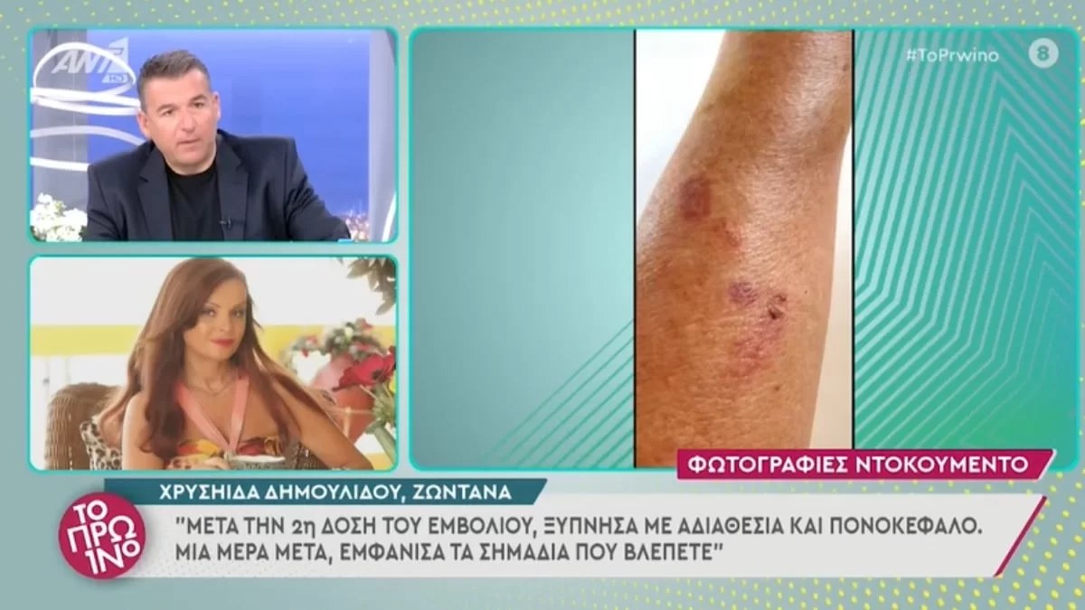 Σάλος στο Πρωινό - Η Χρυσηίδα Δημουλίδου κατήγγειλε ότι έπαθε λύκο μετά το εμβόλιο του κορωνοϊού