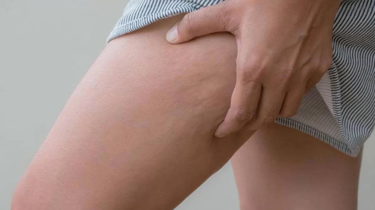 Τρίψε λάδι και κανέλα στα πόδια σου και θα τρελαθείς - Το σούπερ μείγμα κατά της κυτταρίτιδας