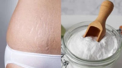 "Εξαφάνισε" στο λεπτό τις ραγάδες μόνο με μαγειρική σόδα και... - Θα σας "λύσει" τα χέρια