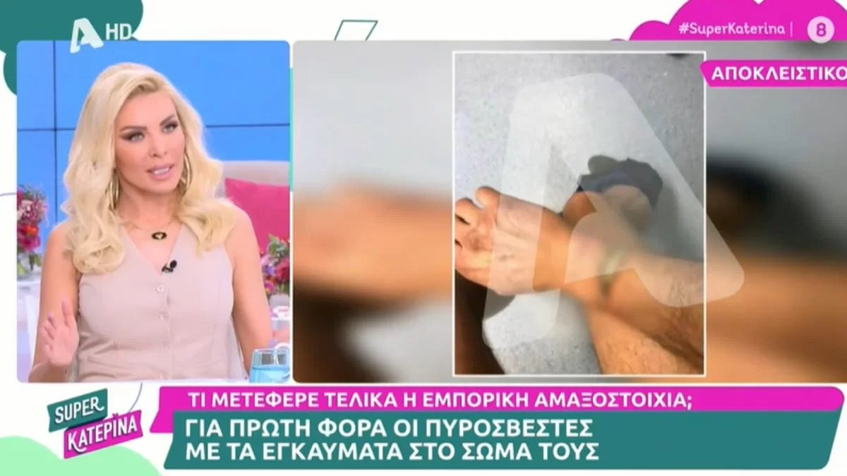 Τέμπη: Ανατριχιαστικό - Φωτογραφίες από τα εγκαύματα στα σώματα των πυροσβεστών
